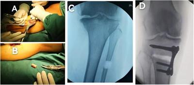 A new technique of autologous bone grafting for open-wedge high tibial osteotomy